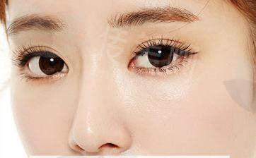 魏志香医生双眼皮变单眼皮手术怎么样?有效改善双眼皮粘连