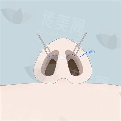 北京高亚东鼻综合技术怎么样?鼻整形修复案例公开