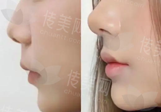 漳州市医院整形科怎么样?医院简介|隆鼻案例展示!