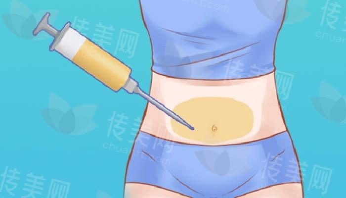 土麦森吸脂是什么?和普通吸脂有什么区别