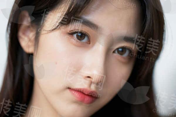 上海杜园园整容失败修复,双眼皮失败修复案例分享及价格参考